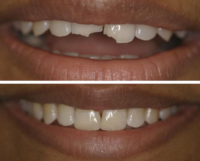 Наращивание зубов в Оренбурге