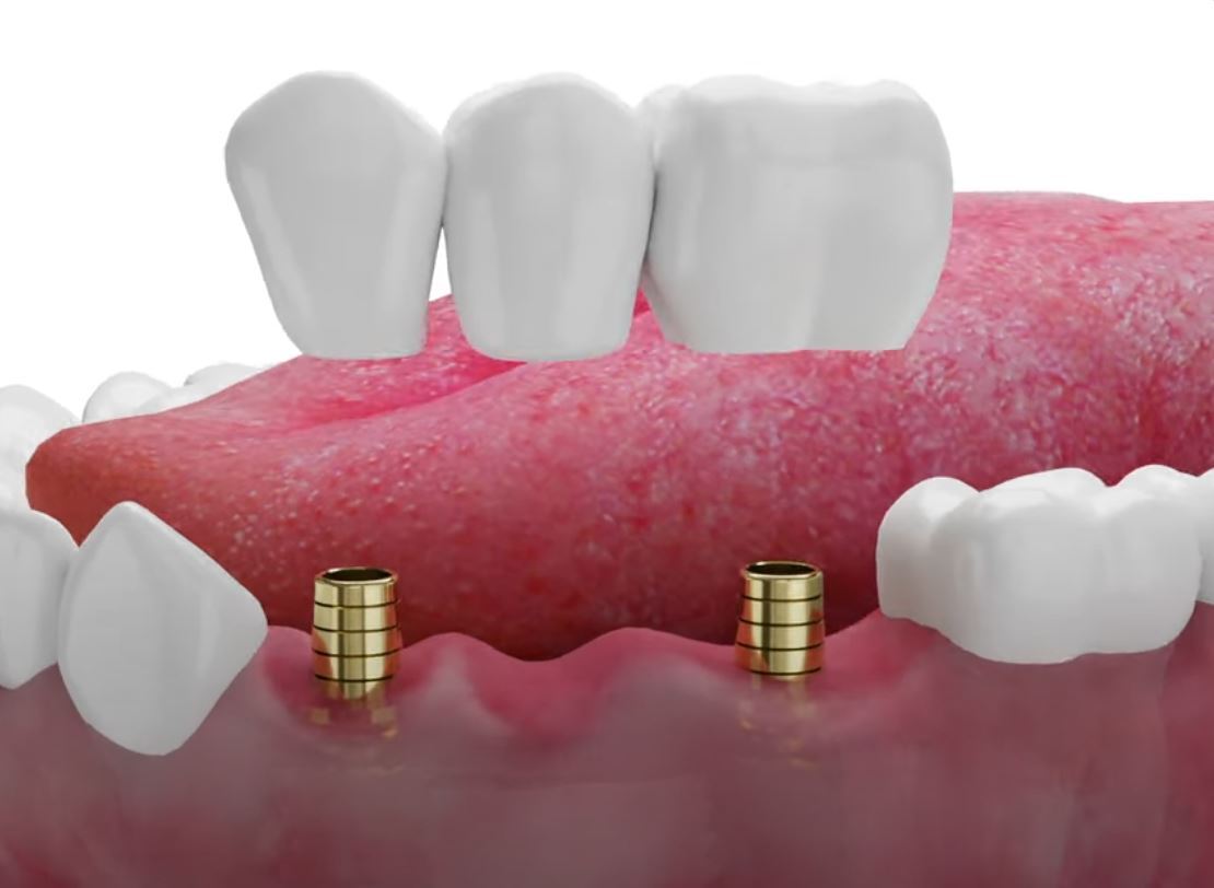 Протезирование на имплантах в Оренбурге Имплантация зубов в Оренбурге