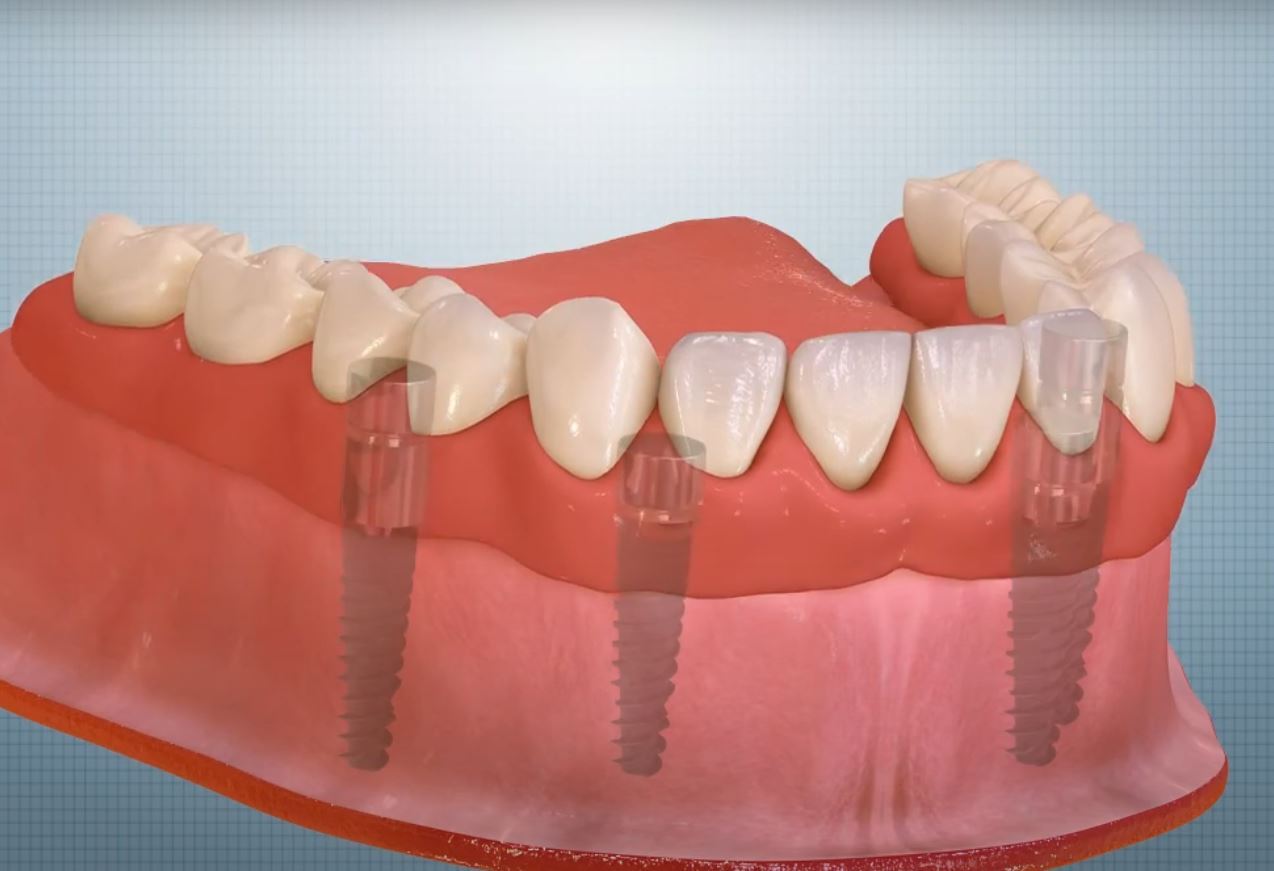 Все на 4 в Оренбурге Имплантация зубов all-on-4 в Оренбурге